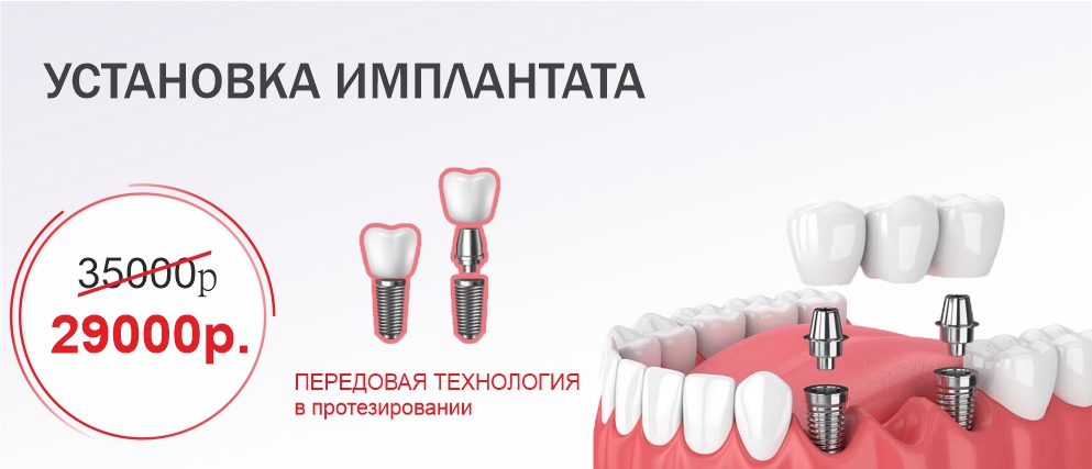Установка зубного импланта