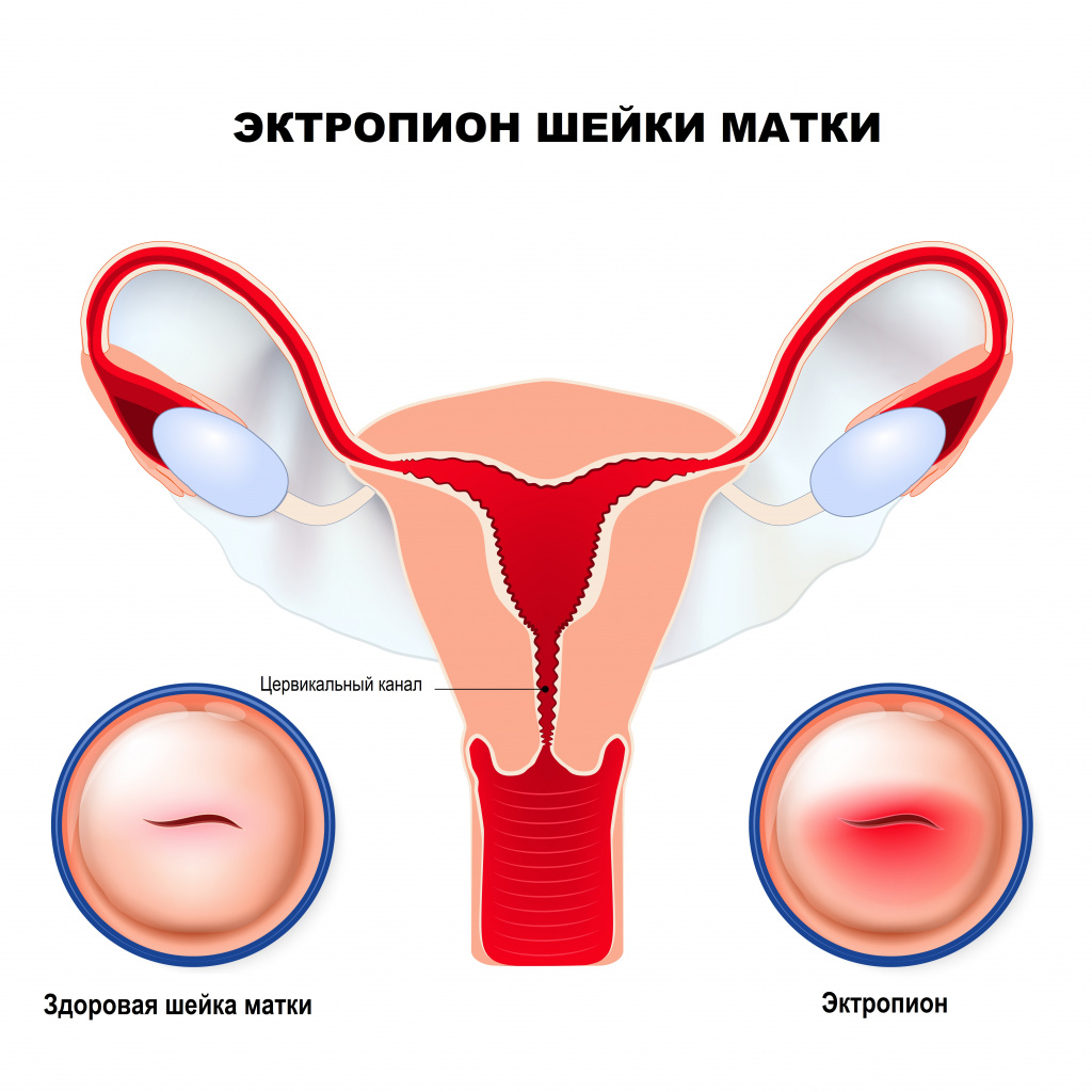 Эрозия шейки матки: симптомы, лечение, причины и профилактика